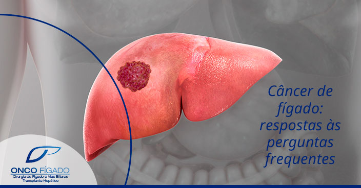 CÂNCER DE FÍGADO: RESPOSTAS ÀS PERGUNTAS FREQUENTES 1